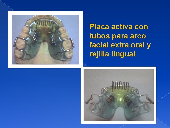 Placa activa con tubos para arco facial extra oral y rejilla lingual 