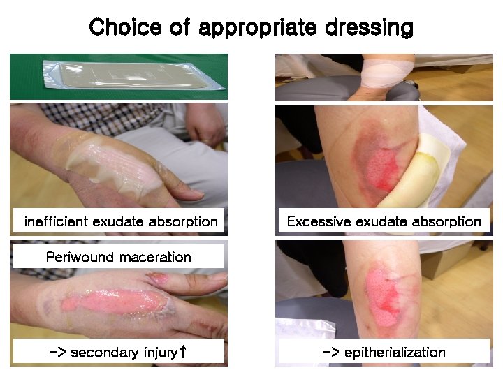 Choice of appropriate dressing inefficient exudate absorption Excessive exudate absorption Periwound maceration -> secondary