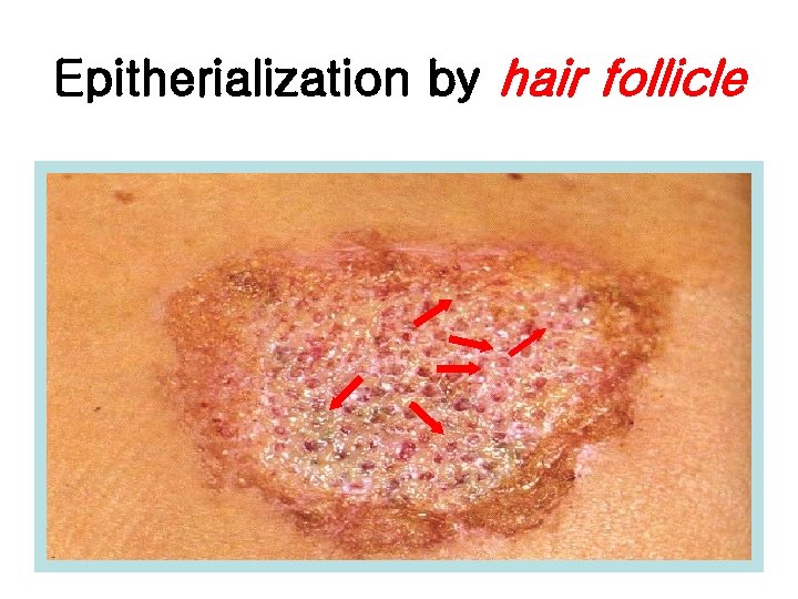 Epitherialization by hair follicle 