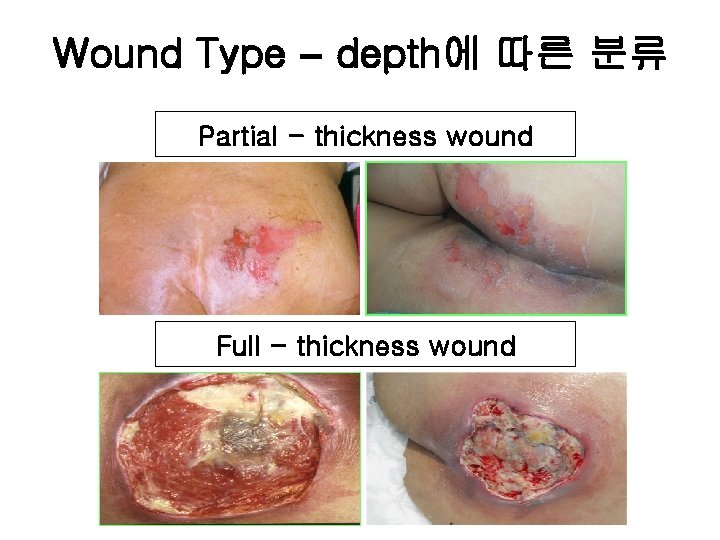 Wound Type – depth에 따른 분류 Partial - thickness wound Full - thickness wound