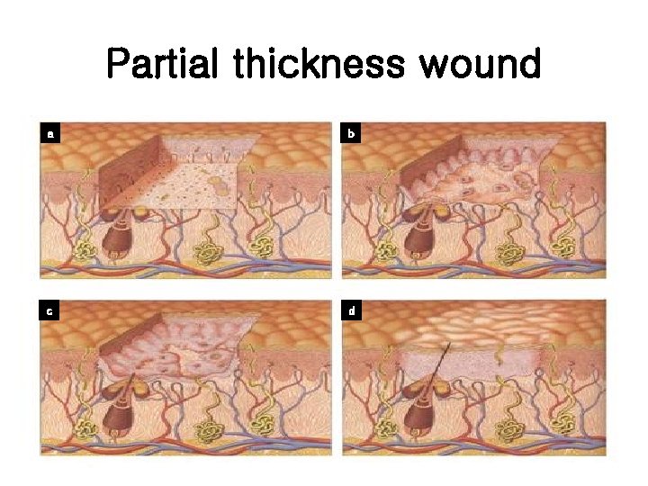 Partial thickness wound a b c d 