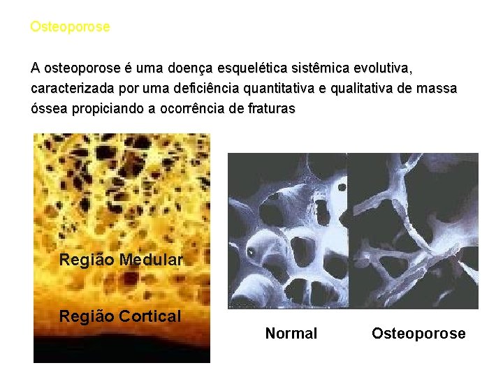 Osteoporose A osteoporose é uma doença esquelética sistêmica evolutiva, caracterizada por uma deficiência quantitativa
