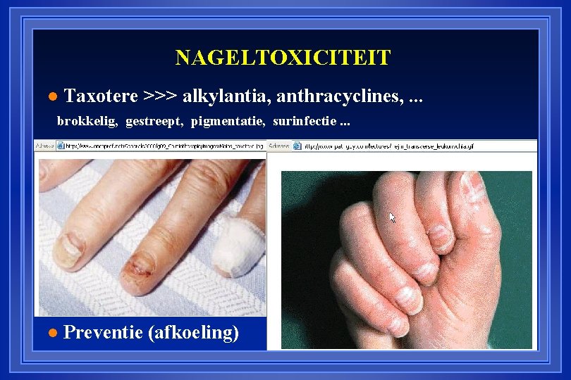 NAGELTOXICITEIT l Taxotere >>> alkylantia, anthracyclines, . . . brokkelig, gestreept, pigmentatie, surinfectie. .