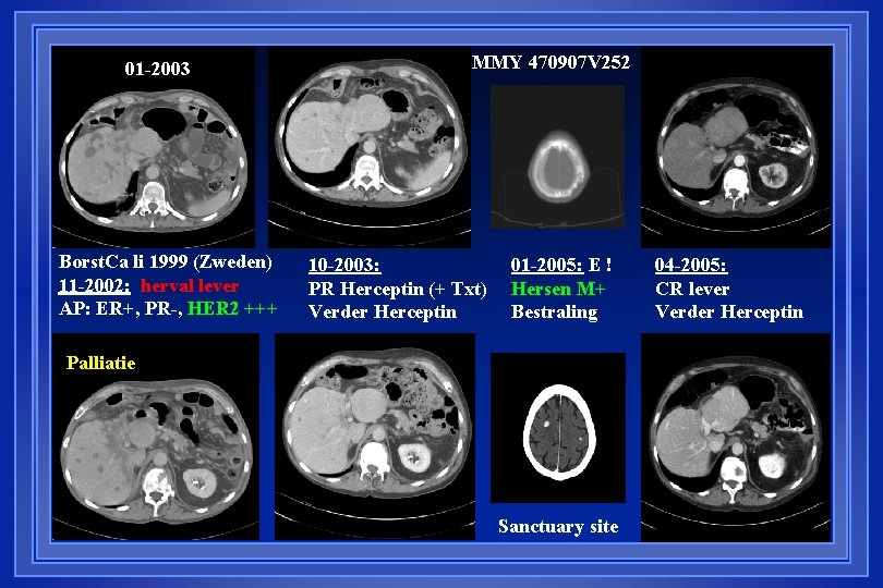 01 -2003 Borst. Ca li 1999 (Zweden) 11 -2002: herval lever AP: ER+, PR-,