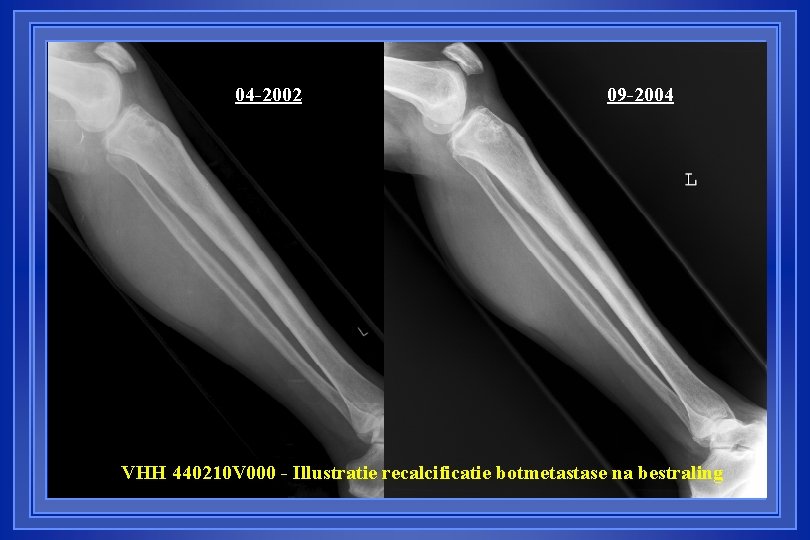 04 -2002 09 -2004 VHH 440210 V 000 - Illustratie recalcificatie botmetastase na bestraling