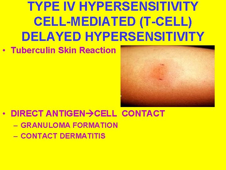 TYPE IV HYPERSENSITIVITY CELL-MEDIATED (T-CELL) DELAYED HYPERSENSITIVITY • Tuberculin Skin Reaction • DIRECT ANTIGEN