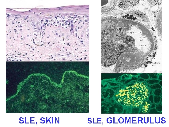 SLE, SKIN SLE, GLOMERULUS 