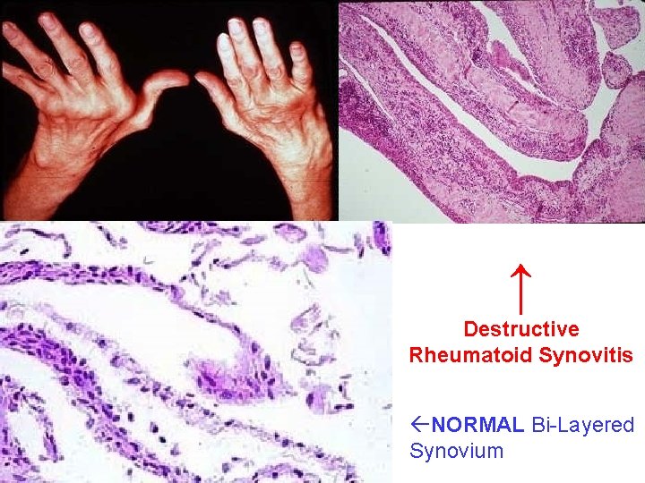 ↑ Destructive Rheumatoid Synovitis NORMAL Bi-Layered Synovium 
