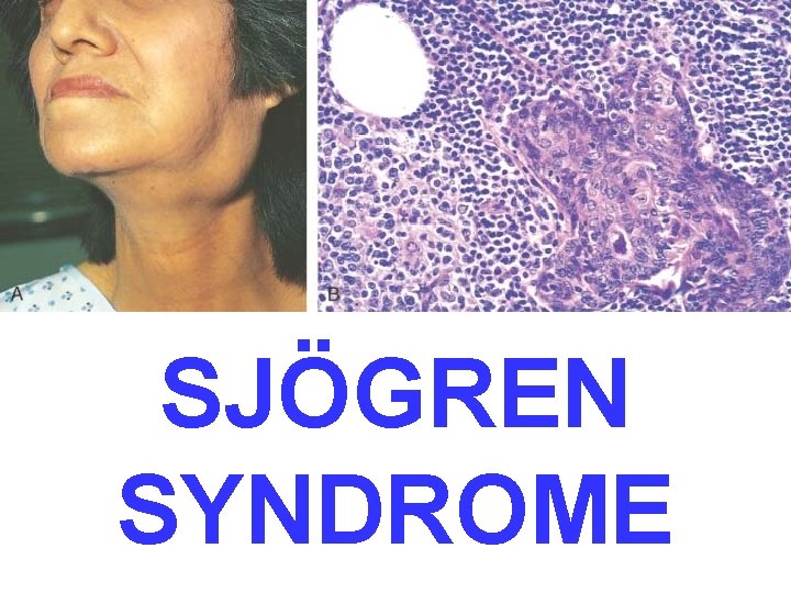 SJÖGREN SYNDROME 