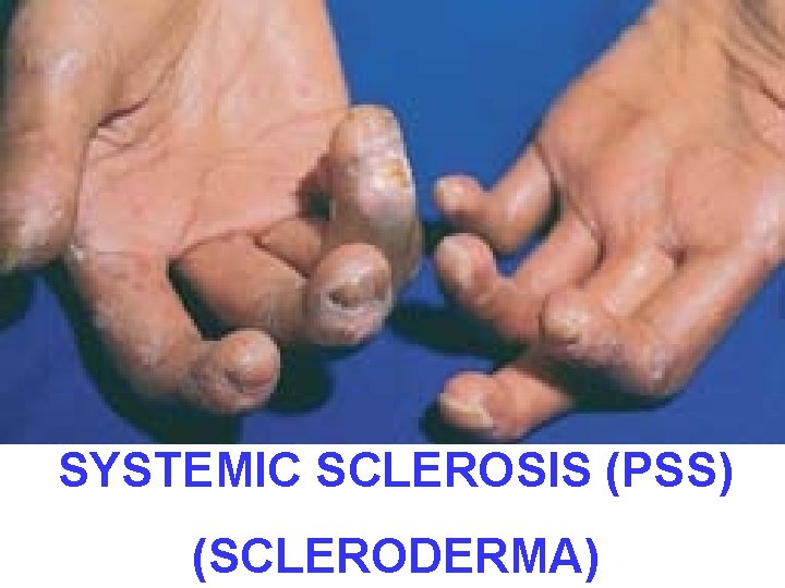 SYSTEMIC SCLEROSIS (PSS) (SCLERODERMA) 