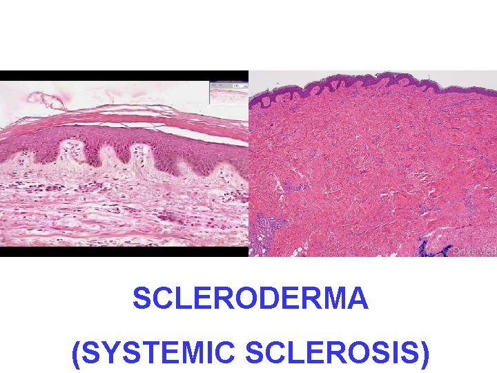 SCLERODERMA (SYSTEMIC SCLEROSIS) 