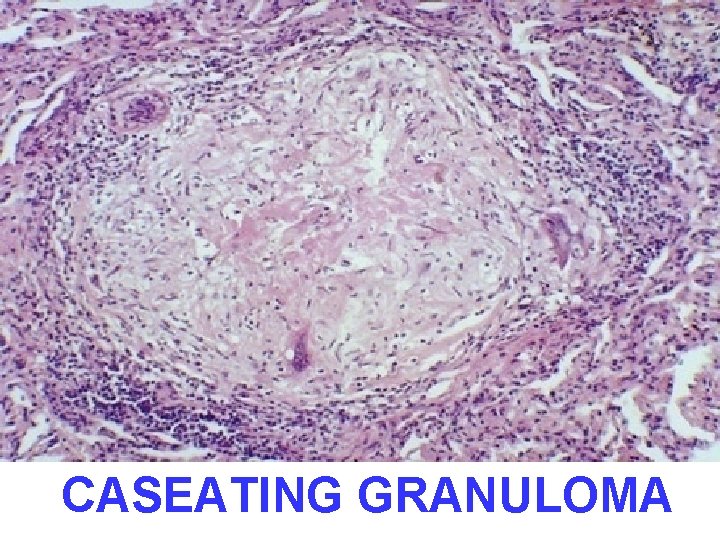 CASEATING GRANULOMA 