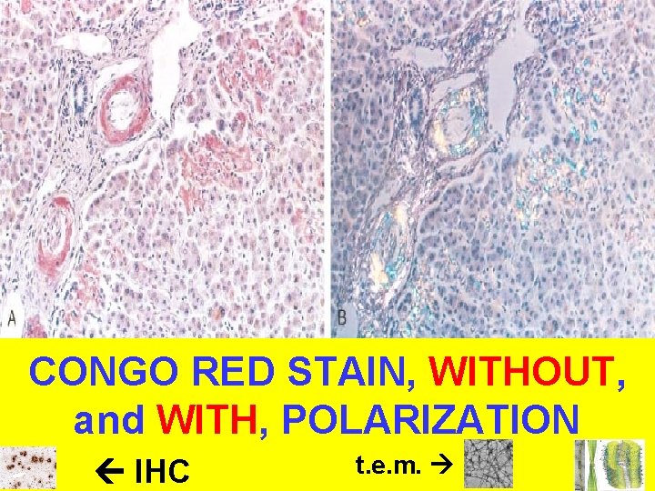 CONGO RED STAIN, WITHOUT, and WITH, POLARIZATION IHC t. e. m. 