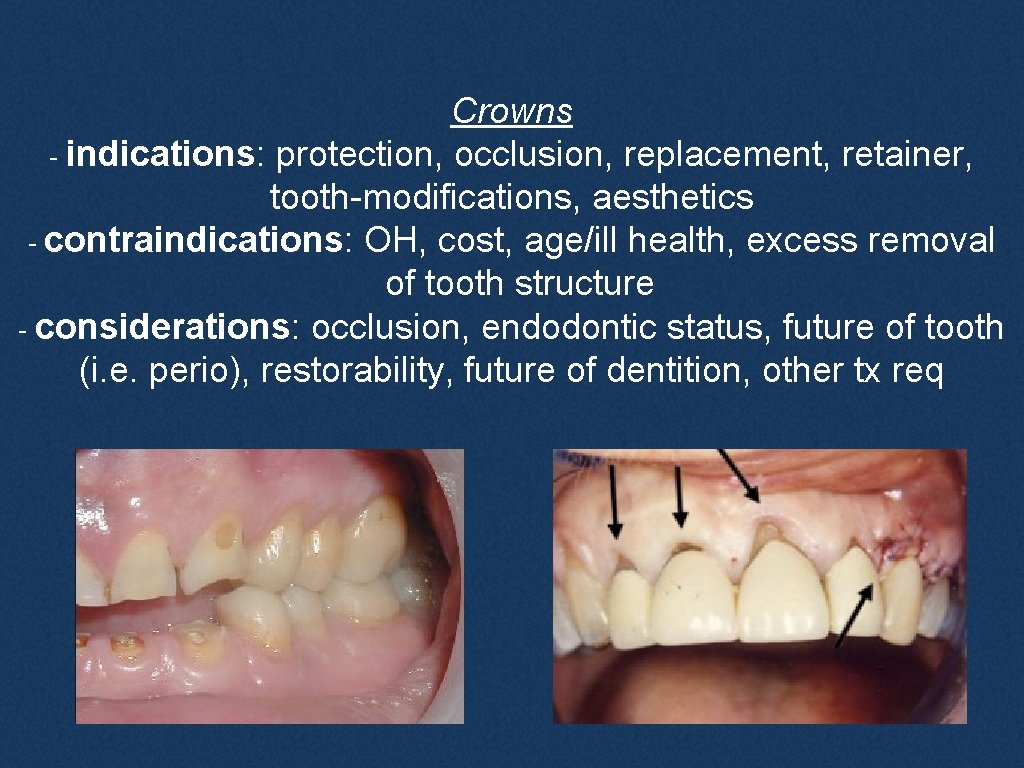 Crowns - indications: protection, occlusion, replacement, retainer, tooth-modifications, aesthetics - contraindications: OH, cost, age/ill