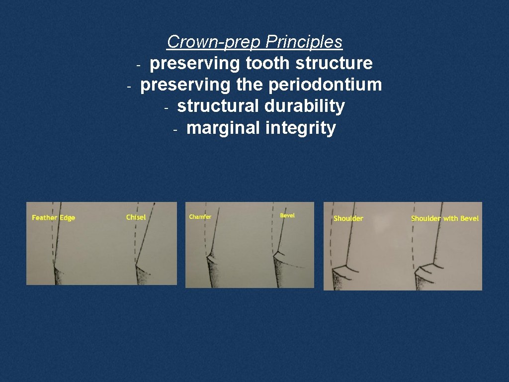 Crown-prep Principles - preserving tooth structure - preserving the periodontium - structural durability -