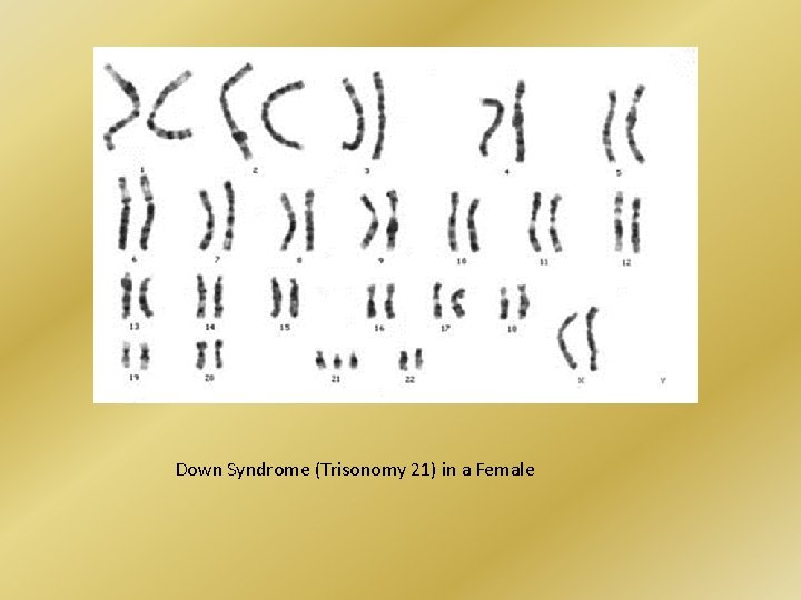 Down Syndrome (Trisonomy 21) in a Female 