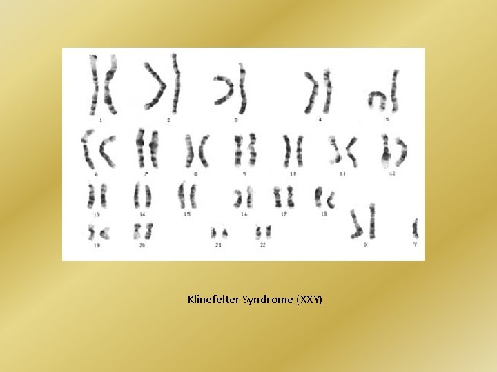 Klinefelter Syndrome (XXY) 