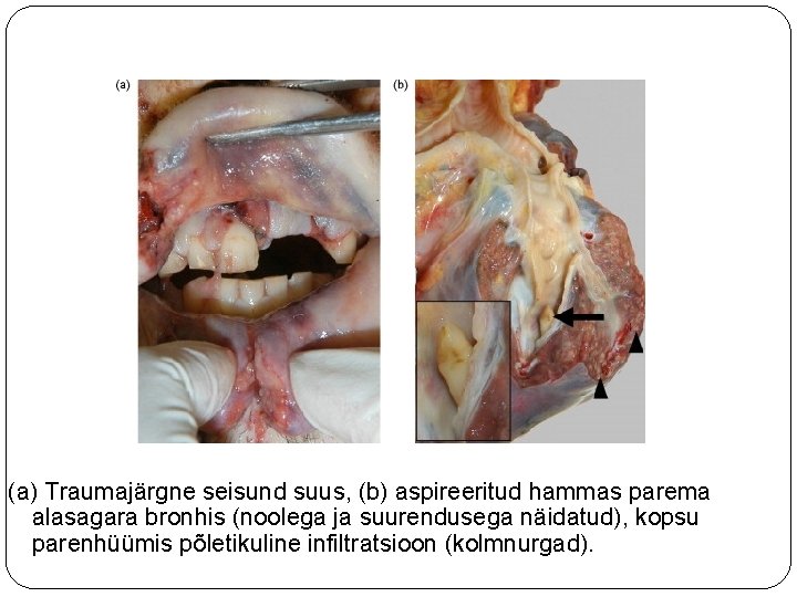 (a) Traumajärgne seisund suus, (b) aspireeritud hammas parema alasagara bronhis (noolega ja suurendusega näidatud),