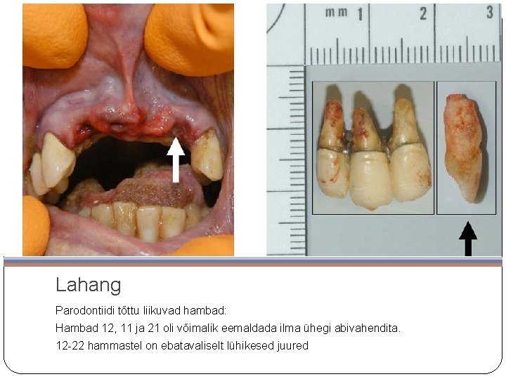 Lahang Parodontiidi tõttu liikuvad hambad: Hambad 12, 11 ja 21 oli võimalik eemaldada ilma