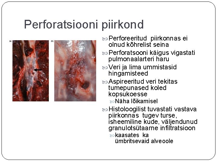 Perforatsiooni piirkond Perforeeritud piirkonnas ei olnud kõhrelist seina Perforatsooni käigus vigastati pulmonaalarteri haru Veri