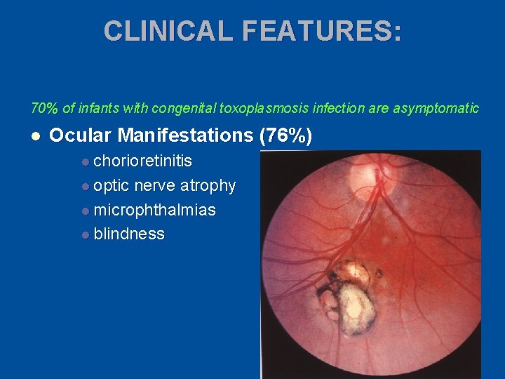 CLINICAL FEATURES: 70% of infants with congenital toxoplasmosis infection are asymptomatic l Ocular Manifestations