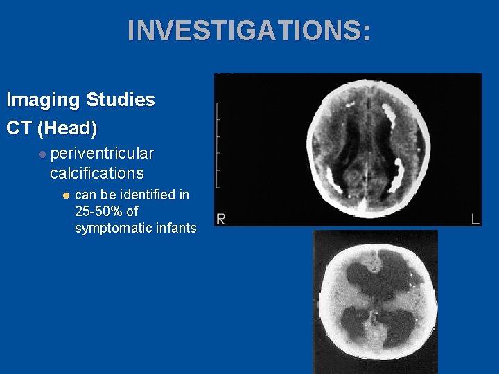 INVESTIGATIONS: Imaging Studies CT (Head) l periventricular calcifications l can be identified in 25