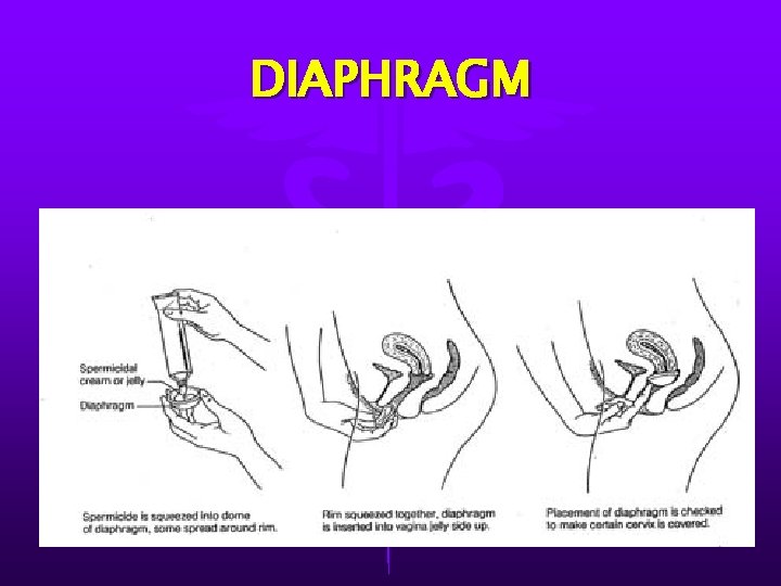 DIAPHRAGM 
