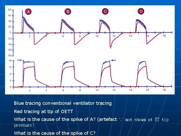 Blue tracing conventional ventilator tracing Red tracing at tip of OETT What is the
