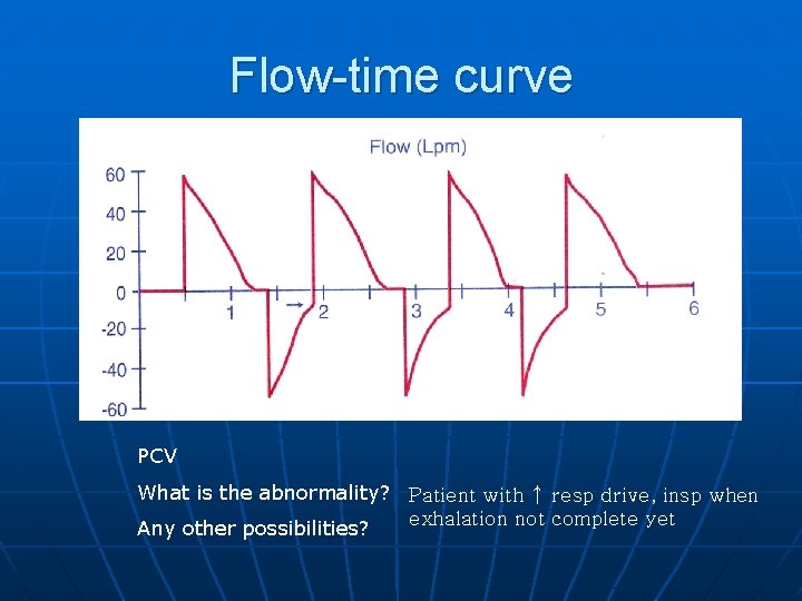 Flow-time curve PCV What is the abnormality? Patient with ↑ resp drive, insp when