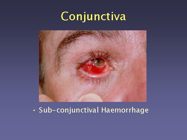 Conjunctiva • Sub-conjunctival Haemorrhage 