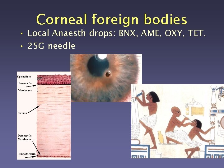 Corneal foreign bodies • Local Anaesth drops: BNX, AME, OXY, TET. • 25 G