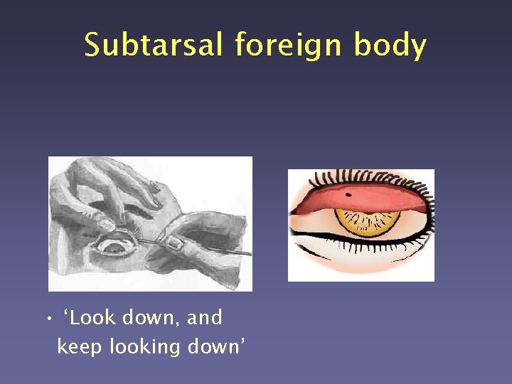Subtarsal foreign body • ‘Look down, and keep looking down’ 