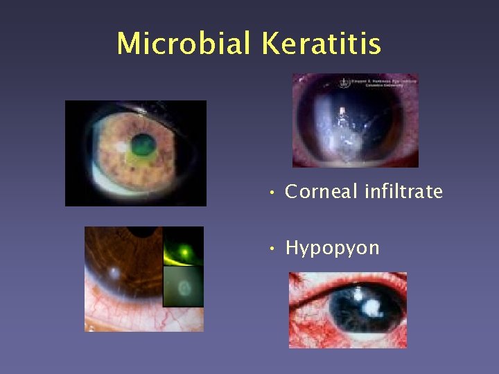 Microbial Keratitis • Corneal infiltrate • Hypopyon 