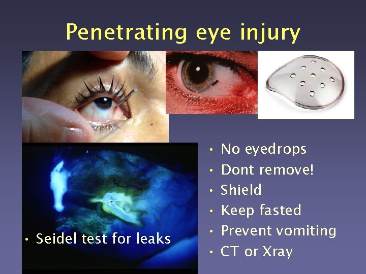 Penetrating eye injury • Seidel test for leaks • • • No eyedrops Dont