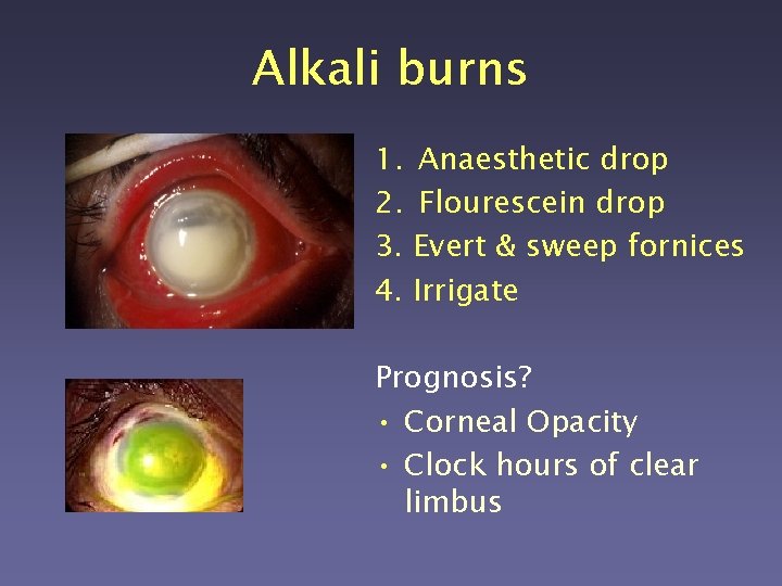 Alkali burns 1. Anaesthetic drop 2. Flourescein drop 3. Evert & sweep fornices 4.