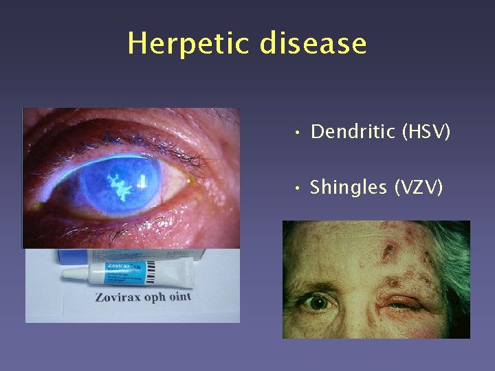 Herpetic disease • Dendritic (HSV) • Shingles (VZV) 