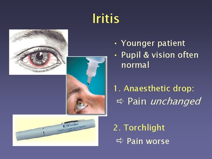 Iritis • Younger patient • Pupil & vision often normal 1. Anaesthetic drop: Pain