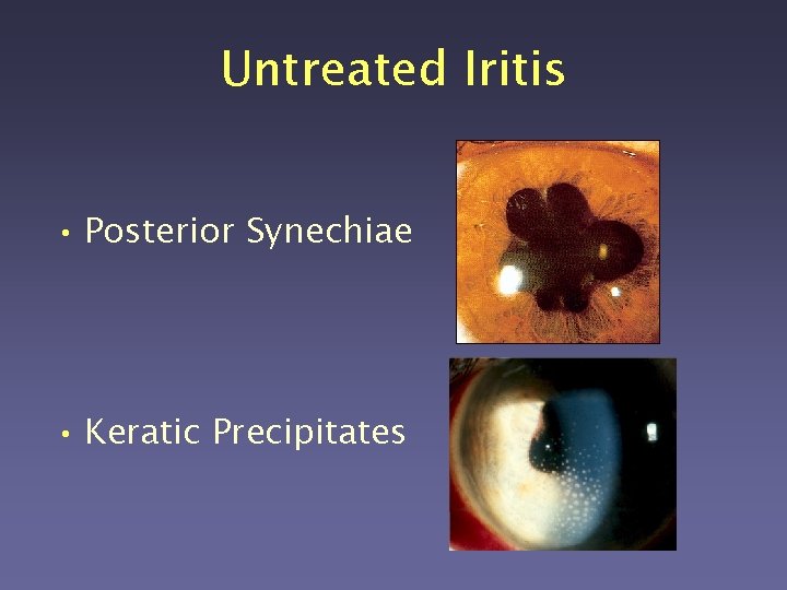 Untreated Iritis • Posterior Synechiae • Keratic Precipitates 