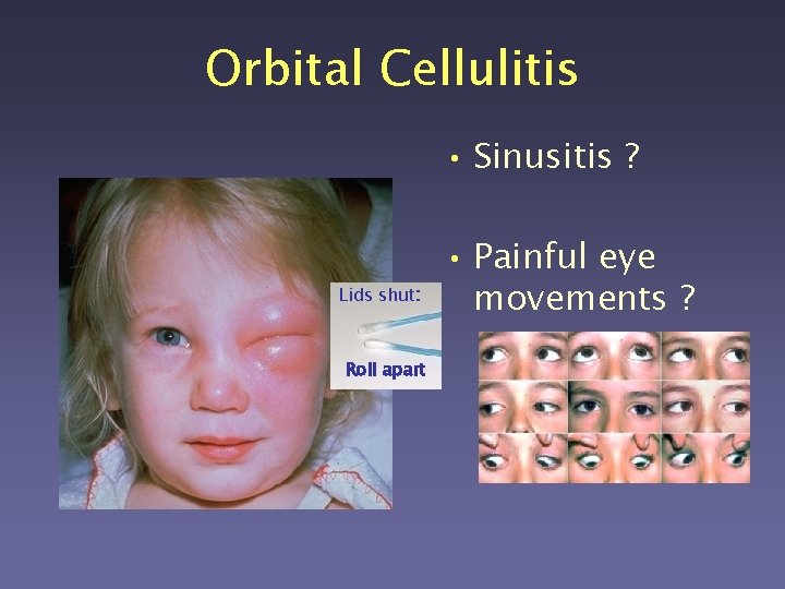 Orbital Cellulitis • Sinusitis ? Lids shut: Roll apart • Painful eye movements ?