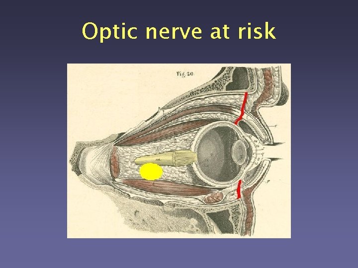 Optic nerve at risk 