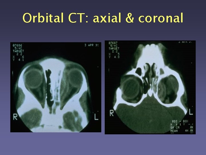 Orbital CT: axial & coronal 