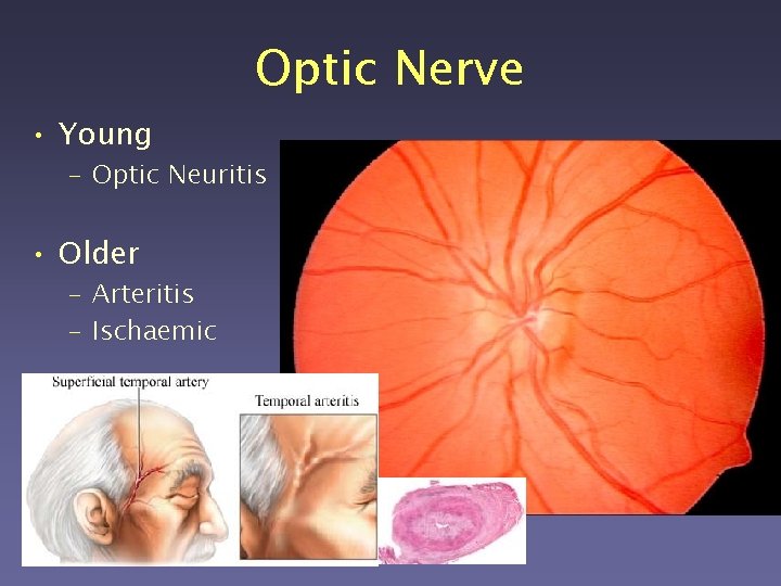 Optic Nerve • Young – Optic Neuritis • Older – Arteritis – Ischaemic 