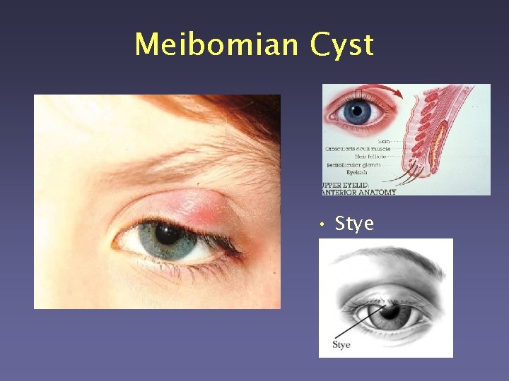 Meibomian Cyst • Stye 