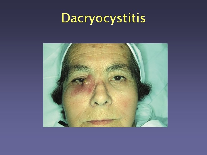 Dacryocystitis 