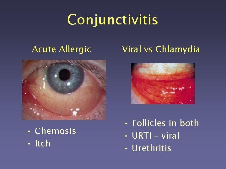 Conjunctivitis Acute Allergic • Chemosis • Itch Viral vs Chlamydia • Follicles in both