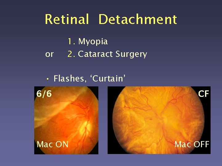 Retinal Detachment or 1. Myopia 2. Cataract Surgery • Flashes, ‘Curtain’ 6/6 Mac ON