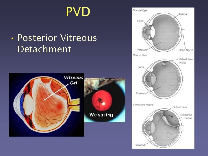 PVD • Posterior Vitreous Detachment Weiss ring 
