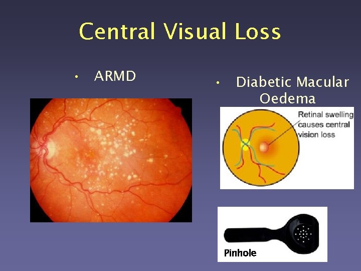 Central Visual Loss • ARMD • Diabetic Macular Oedema Pinhole 