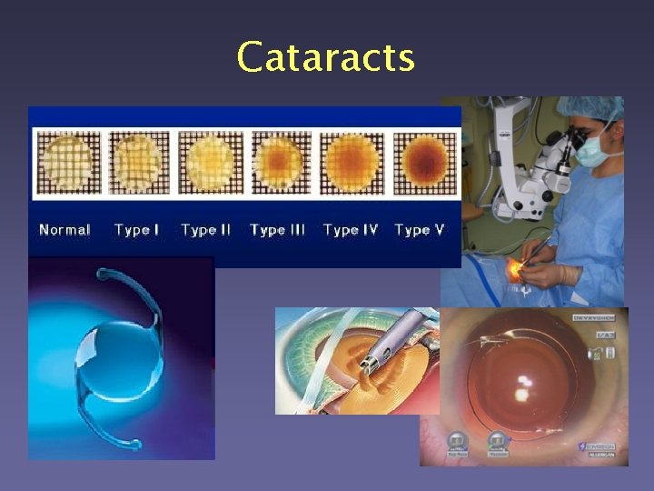 Cataracts 