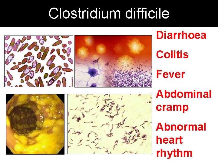 Clostridium difficile Diarrhoea Colitis Fever Abdominal cramp Abnormal heart rhythm 